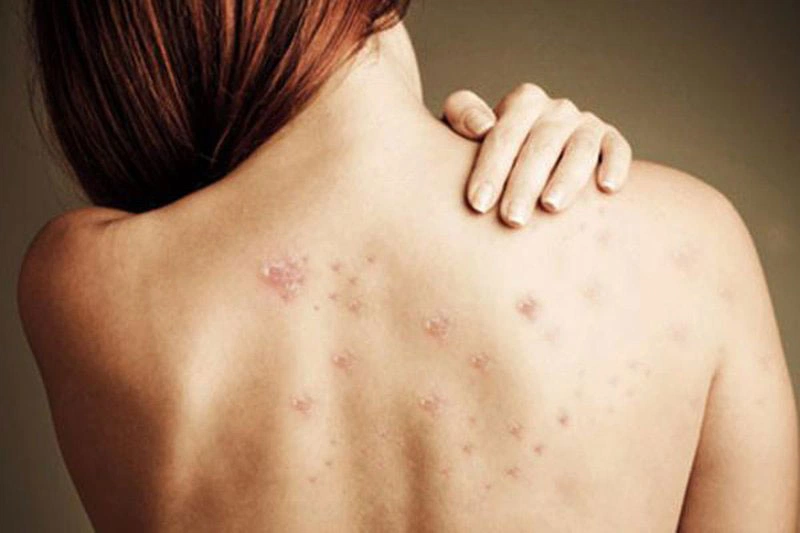 Mụn lưng khiến nhiều chị em tự ti để diện những bộ váy yêu thích