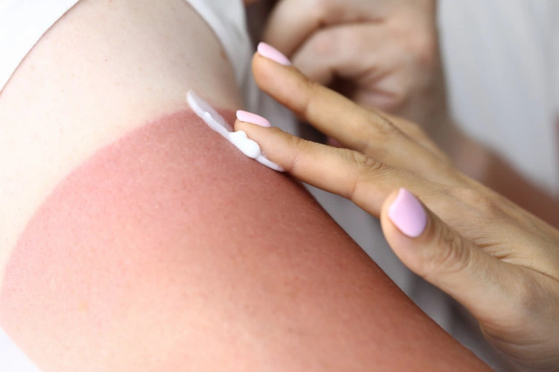Bạn nên làm mát làn da ngay lập tức khi có dấu hiệu da bị cháy nắng