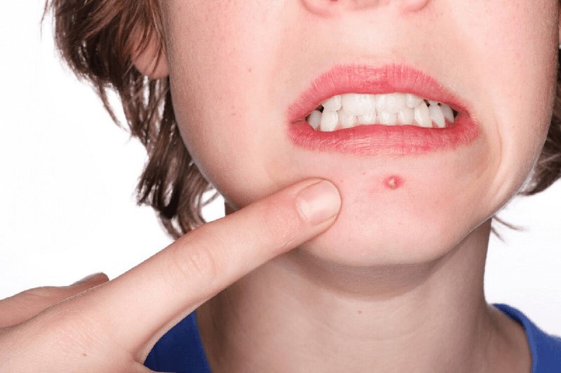 Ăn chôm chôm có nổi mụn không? Ăn chôm chôm có những lợi ích gì? 3