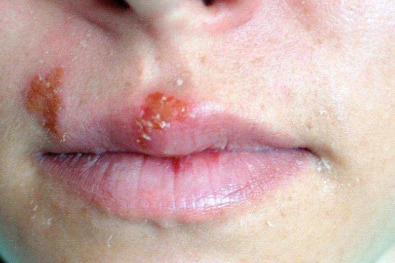 An toàn tình dục khi bị nhiễm HIV: Liệu hôn nhau có bị lây HIV không? 3