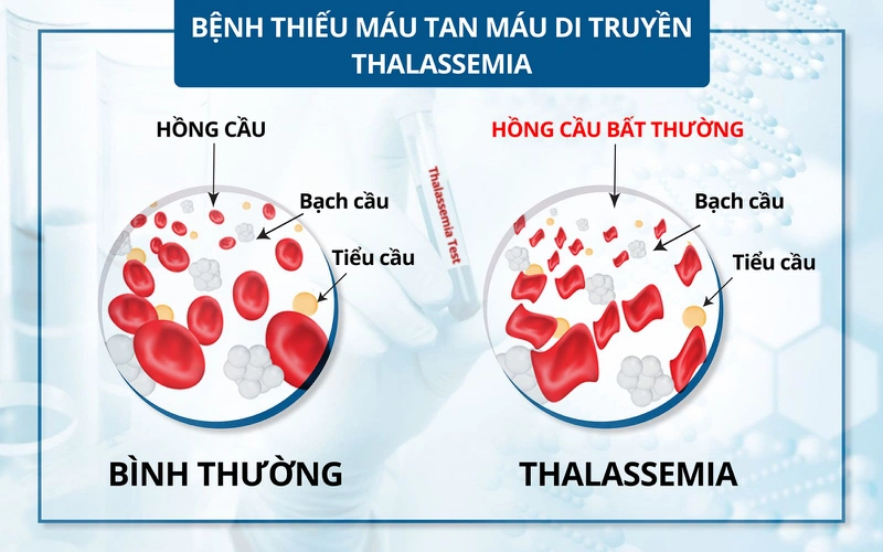 Bệnh tan máu bẩm sinh là gì? Người mắc bệnh tan máu bẩm sinh sống được bao lâu? 4