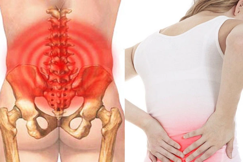 Bác sĩ gợi ý các loại thuốc uống trị đau thần kinh tọa 1