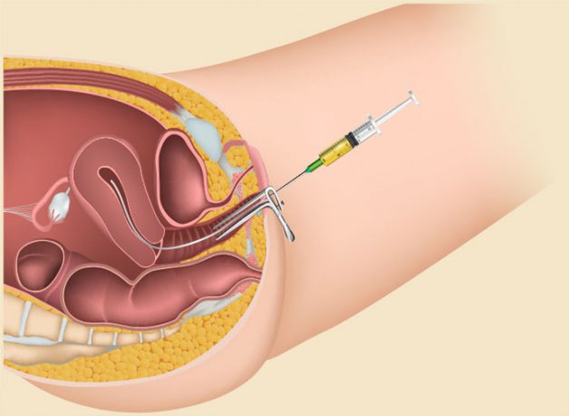 Bách khoa toàn thư giải đáp mọi thắc mắc về tiêm thuốc kích trứng 5