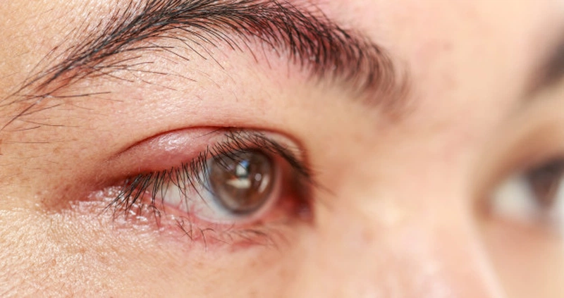 Bệnh lẹo mắt sẽ gây sưng đỏ, đau nhức, có cảm giác cộm ở mắt