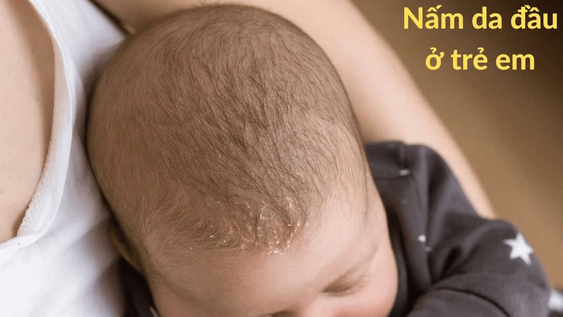 Nấm da đầu ở trẻ em - Cách điều trị an toàn hiệu quả tại nhà