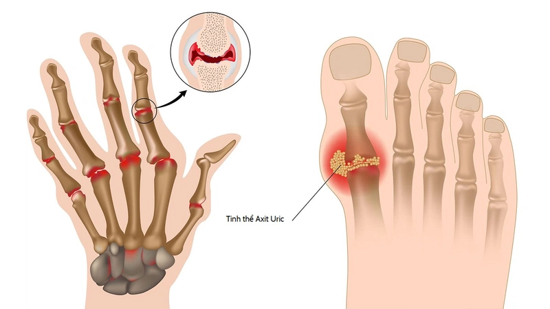 Bệnh nhân Gout có uống nước yến hoặc ăn tổ yến được không 1