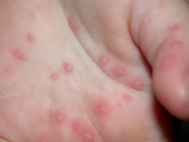 Bệnh tay chân miệng ở trẻ có phải kiêng gió kiêng nước không 2