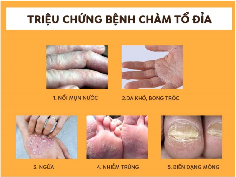 Bệnh tổ đỉa giai đoạn đầu ở da với nhiều dấu hiệu điển hình 2