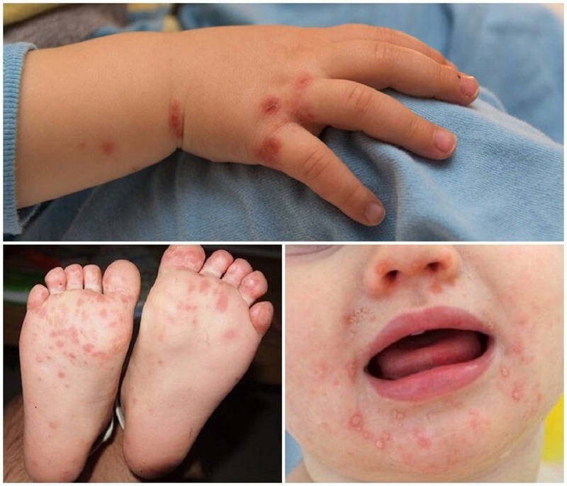 Bệnh truyền nhiễm là gì? Các bệnh truyền nhiễm thường gặp ở trẻ em 2