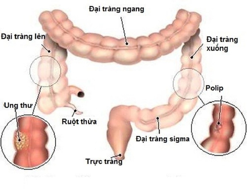 Bệnh viêm trực tràng đi ngoài ra máu có nguy hiểm như thế nào2