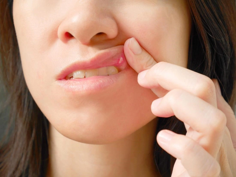 Bị nhiệt miệng bao lâu thì khỏi là thắc mắc chung của nhiều người bệnh hiện nay