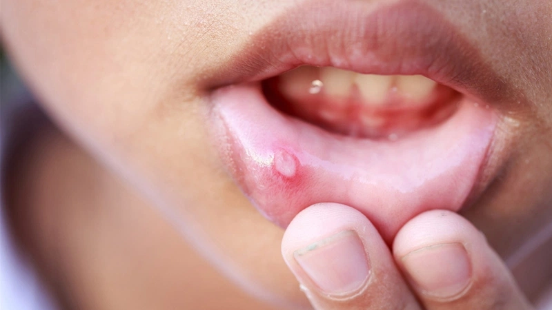 NHiệt miệng kéo dài không điều trị có thể gây nhiễm trùng não