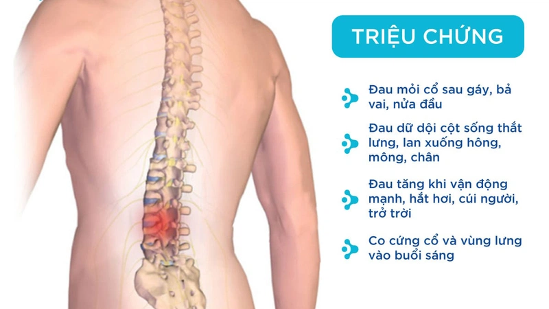 Bị thoái hóa cột sống có nên chạy xe đạp không? Người bệnh cần lưu ý gì khi tập 1