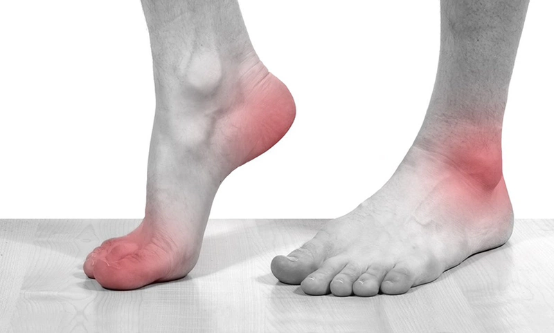 Bong gân, trật khớp là chấn thương hay gặp ở vùng cổ chân