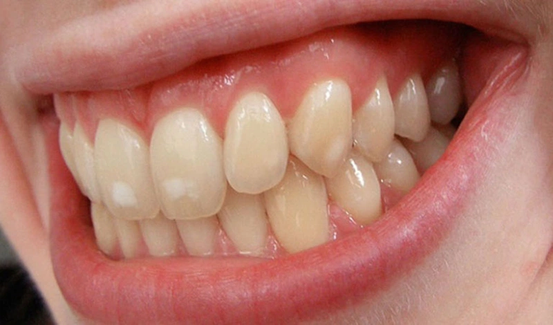 Sâu răng nhẹ có xuất hiện đốm màu trắng sữa hoặc màu ngà