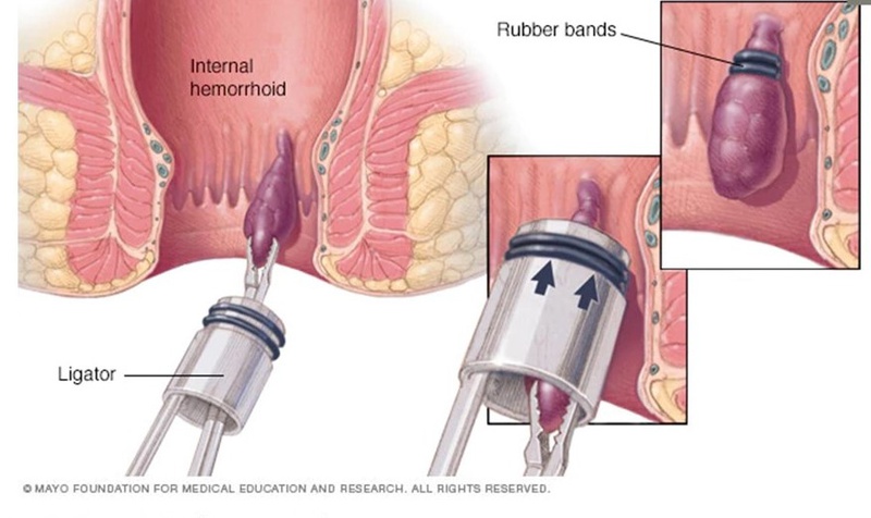 Bệnh trĩ là gì? Các phương pháp chữa bệnh trĩ nào an toàn và hiệu quả 2