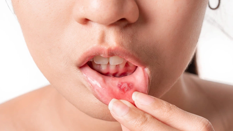Cách chữa nhiệt miệng cho bà bầu cực kỳ an toàn và hiệu quả 1