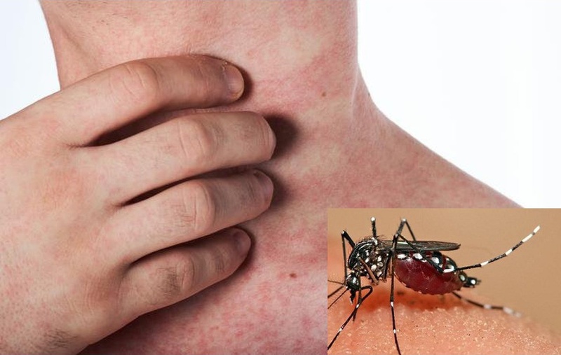 Cách sơ cứu sốt xuất huyết hiệu quả, an toàn 2
