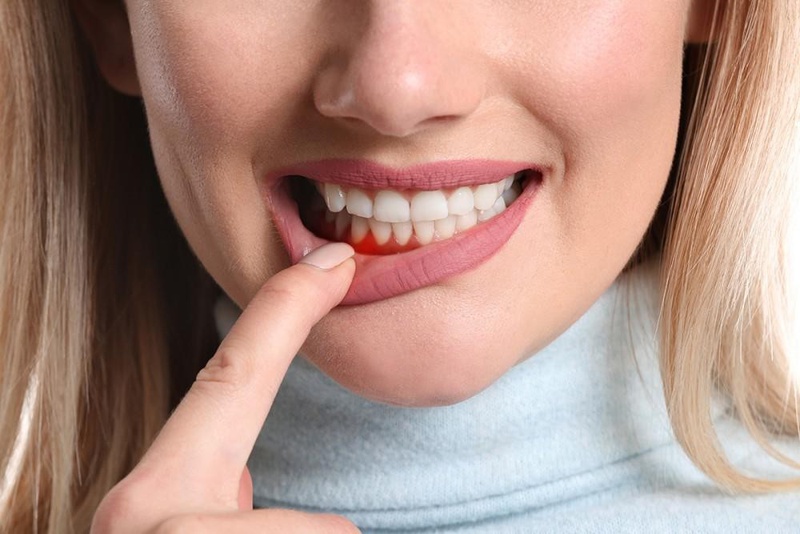 Chảy máu chân răng thiếu chất gì? Phòng tránh chảy máu chân răng như thế nào 1