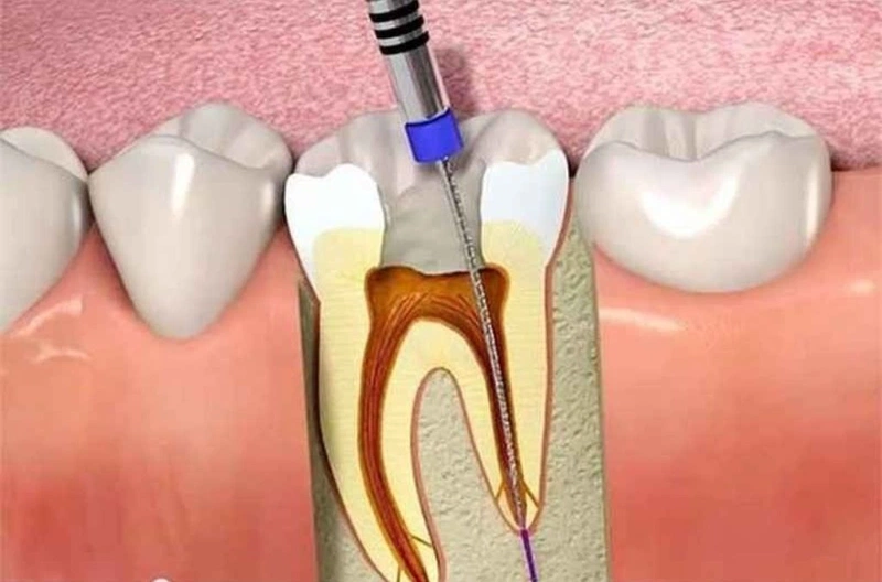 Chữa tủy răng bao lâu sẽ lành? Trường hợp nào thì cần chữa tủy răng? 3