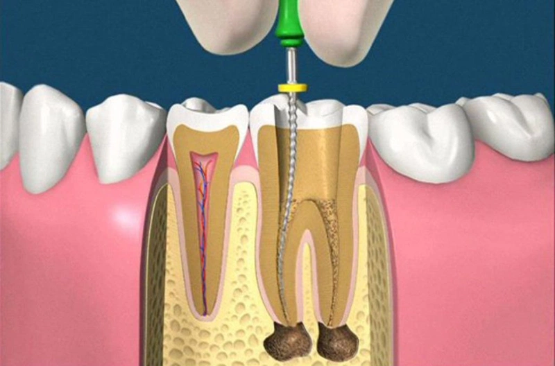 Chữa tủy răng bao lâu sẽ lành? Trường hợp nào thì cần chữa tủy răng? 4