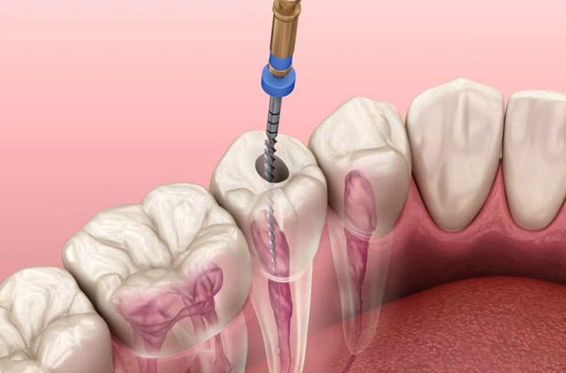 Chữa tủy răng bao lâu sẽ lành? Trường hợp nào thì cần chữa tủy răng? 5