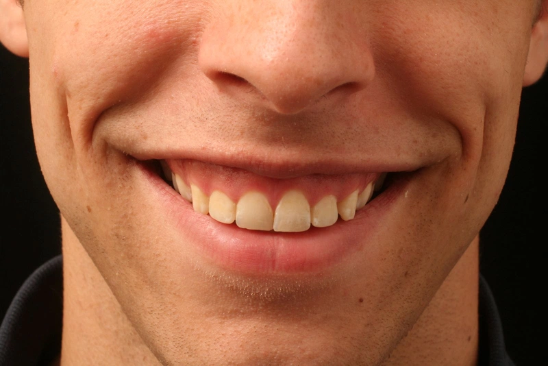 Cười hở lợi là gì? Có thể cải thiện tình trạng cười hở lợi như thế nào? 1