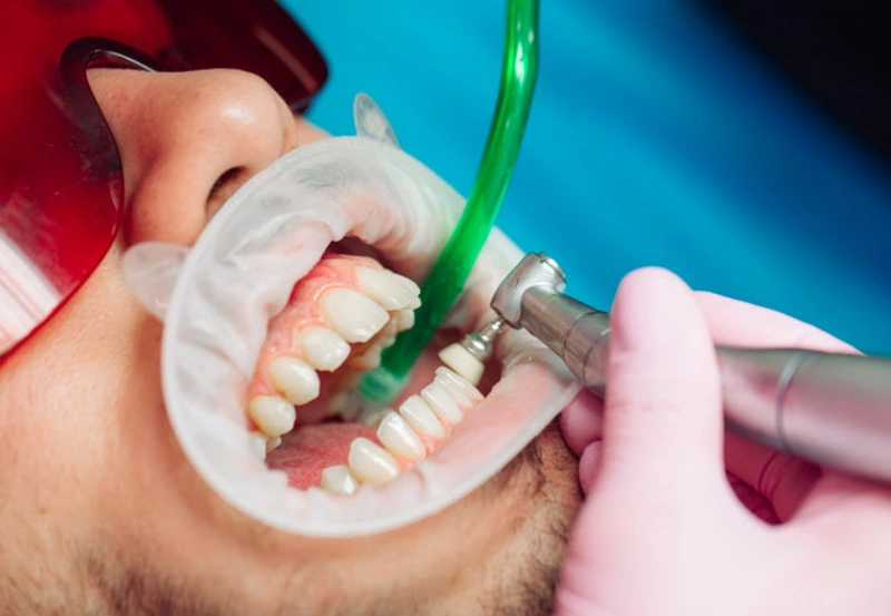Đánh bóng răng có hại không? Lưu ý gì khi đánh bóng răng 2