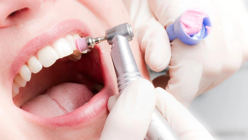 Đánh bóng răng thường được sử dụng sau khi lấy cao răng 