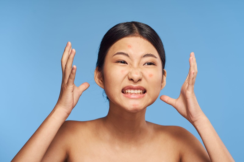 Dấu hiệu bị mụn nội tiết là gì? Nguyên nhân và cách điều trị hiệu quả 2
