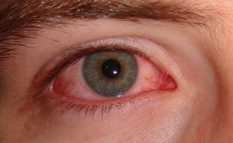 đau mắt hột có nguy hiểm không