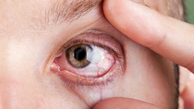 Bệnh đau mắt hột có tự khỏi không?