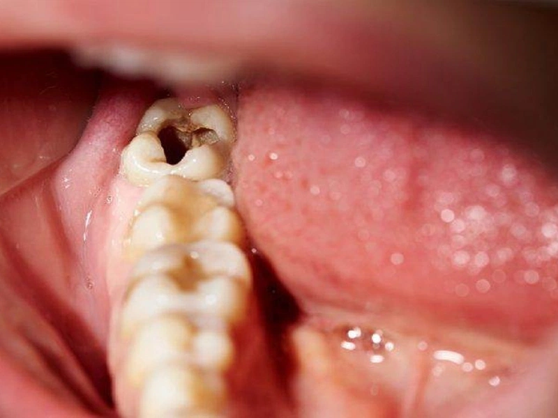 Sâu răng có lây không. câu trả lời là có