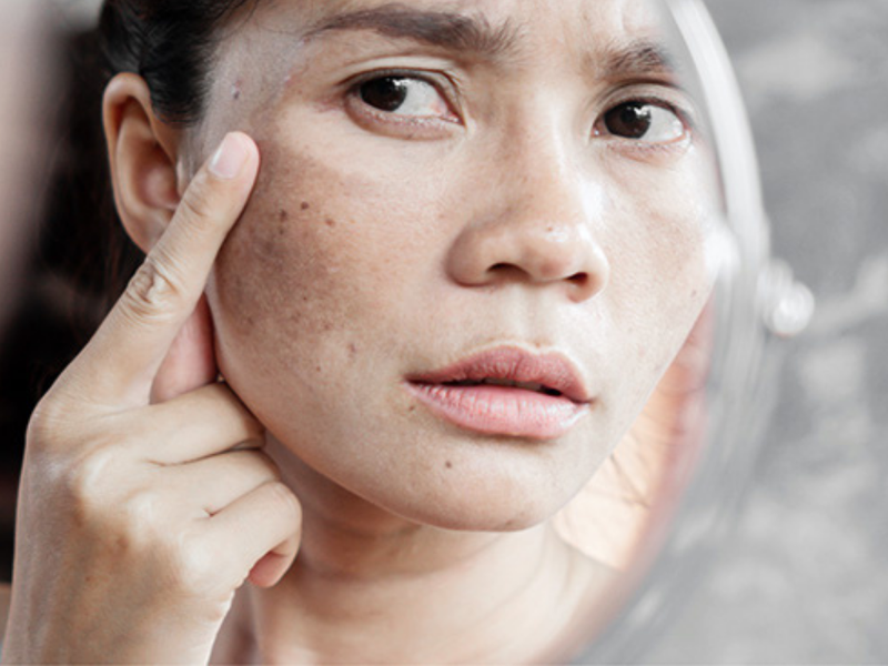 Tìm hiểu bệnh đồi mồi có lây không? 1
