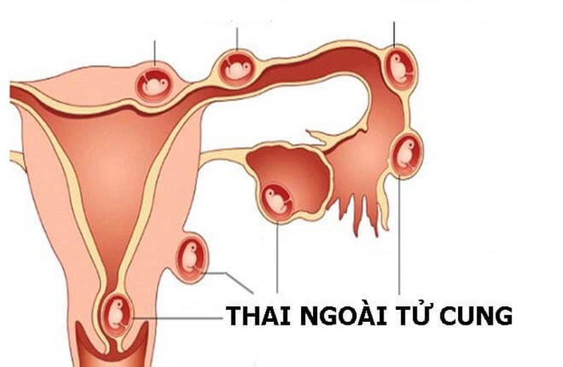 Đừng chủ quan trước những ảnh hưởng của tiêm thuốc rụng trứng đối với cơ thể 4