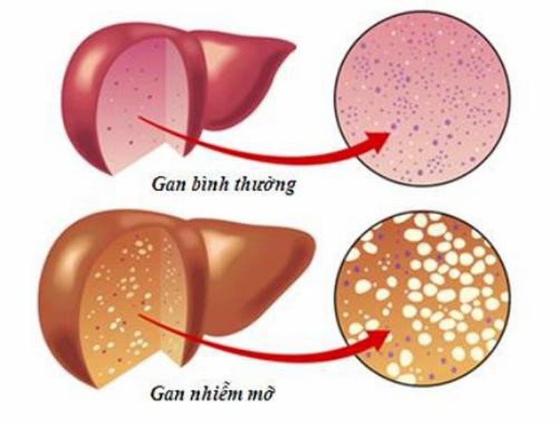 Gan nhiễm mỡ nên kiêng ăn gì? Chế độ dinh dưỡng cho người bị gan nhiễm mỡ 1