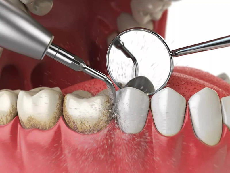 Lấy cao răng giúp loại bỏ mảng bám trên răng