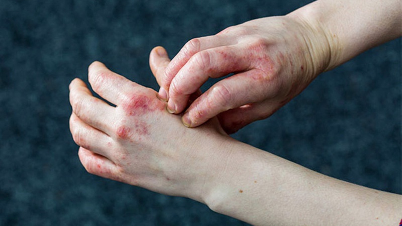 Giải đáp: Bệnh hắc lào có lây nhiễm không 2