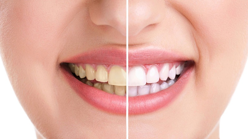 Bị sâu răng có tẩy trắng được không tuỳ thuộc vào mức độ răng sâu