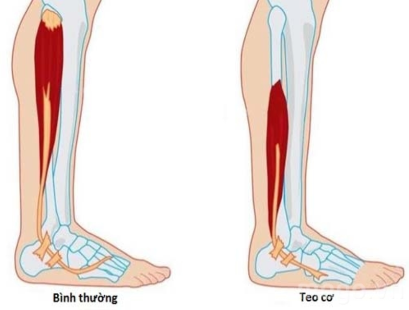 Giải đáp đau thần kinh tọa có chữa khỏi được không 3