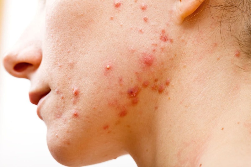 Giải đáp thắc mắc: Tiêm meso là gì? Tiêm meso bị lên mụn là bị làm sao? 1