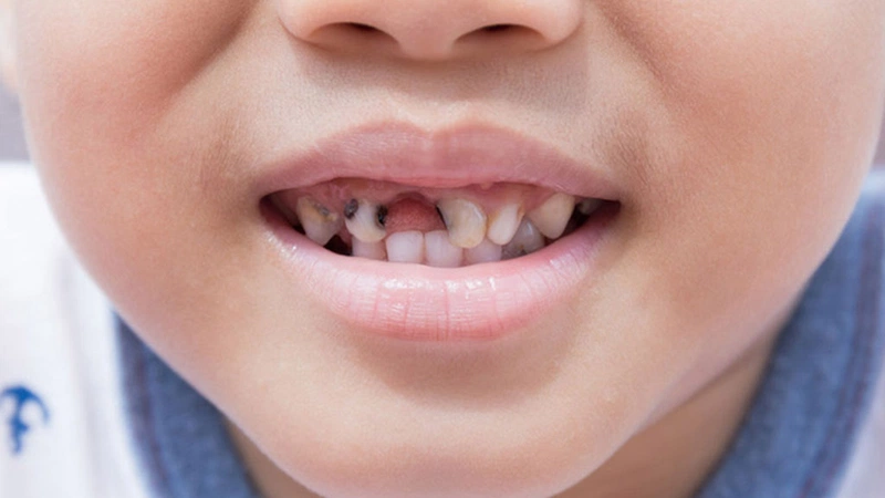 Vì sao trẻ nhỏ hay ăn kẹo rất dễ bị sâu răng?