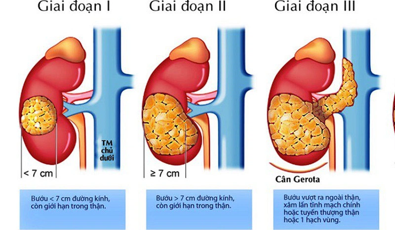 Giới thiệu về u Wilms ở trẻ em và từng giai đoạn của bệnh 2