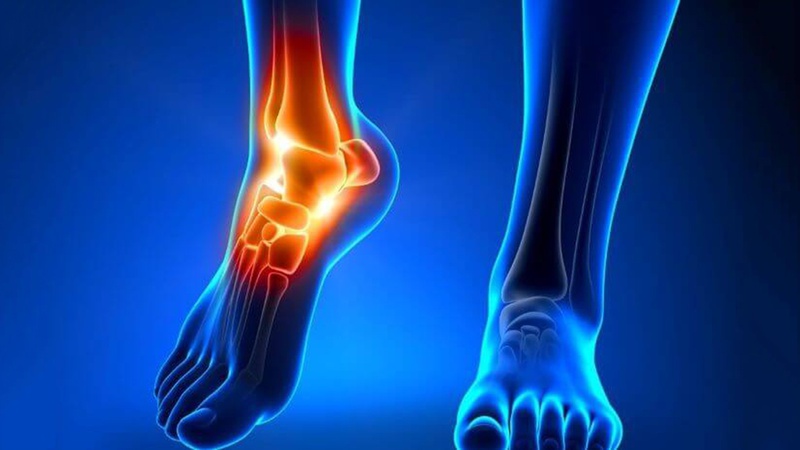 Góc y khoa: Đau khớp cổ chân là bệnh gì? Triệu chứng như thế nào 3