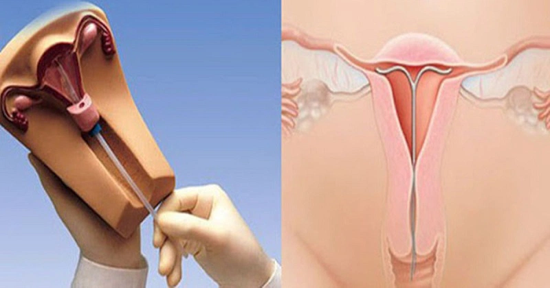 Hiện tượng chảy máu vùng kín sau khi uống thuốc tránh thai khẩn cấp 5