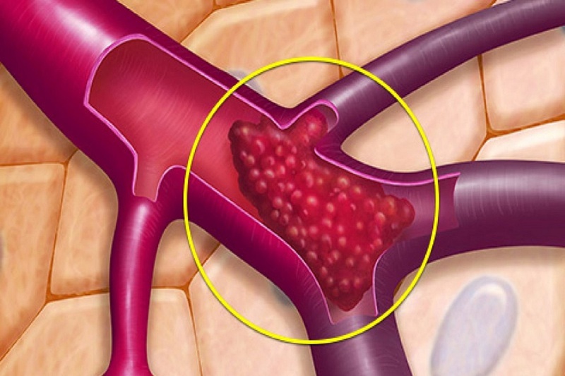 Hội chứng antiphospholipid là gì? Triệu chứng thường gặp trong hội chứng antiphospholipid
