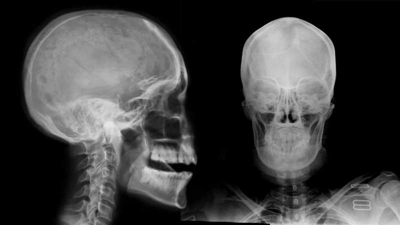 Hội chứng tiền đình Phương pháp điều trị hiệu quả và chẩn đoán chính xác 2