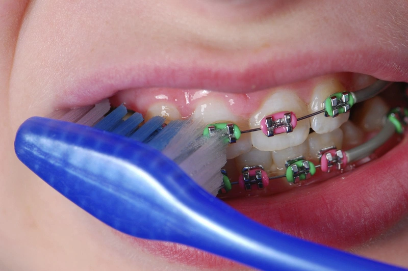 Hướng dẫn vệ sinh răng miệng khi mang mắc cài trong thời gian niềng răng 1