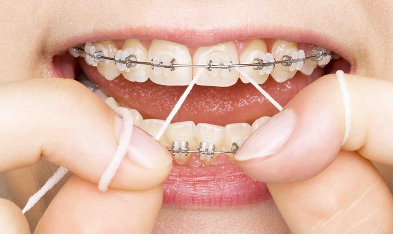 Hướng dẫn vệ sinh răng miệng khi mang mắc cài trong thời gian niềng răng 2