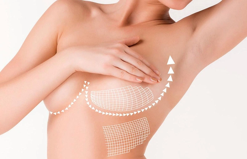 Treo ngực sa trễ bao lâu thì lành? 2